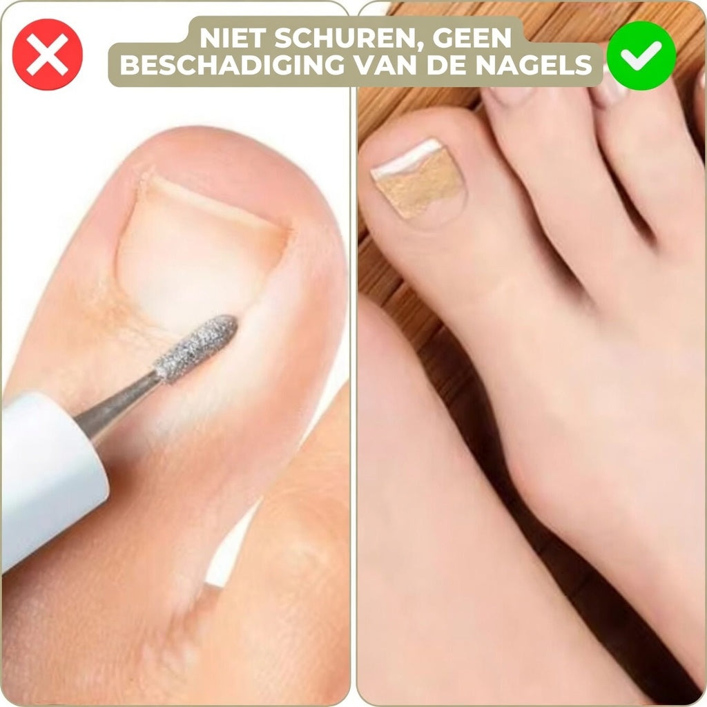 25+25 GRATIS | FixaNail - Onmiddellijke nagelreparatie