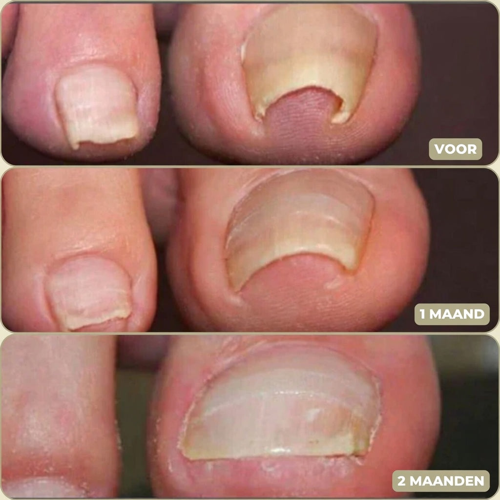 25+25 GRATIS | FixaNail - Onmiddellijke nagelreparatie