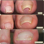 25+25 GRATIS | FixaNail - Onmiddellijke nagelreparatie