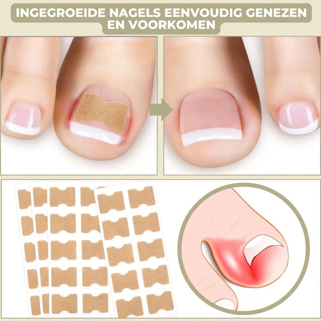 25+25 GRATIS | FixaNail - Onmiddellijke nagelreparatie